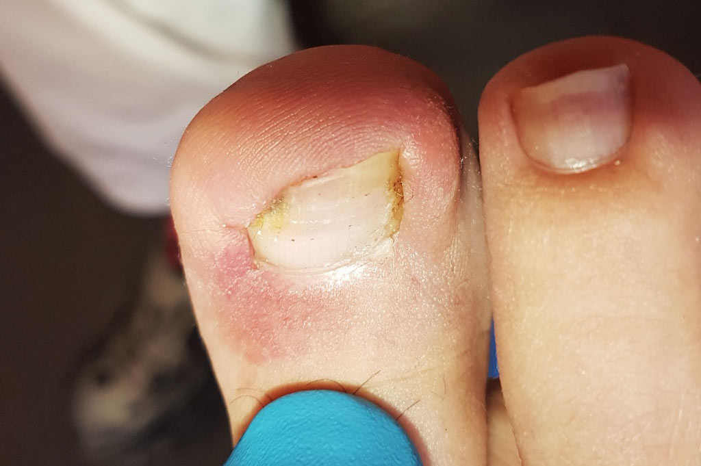 UÑAS-ENCARNADAS-malaga uñas encarnadas en malaga