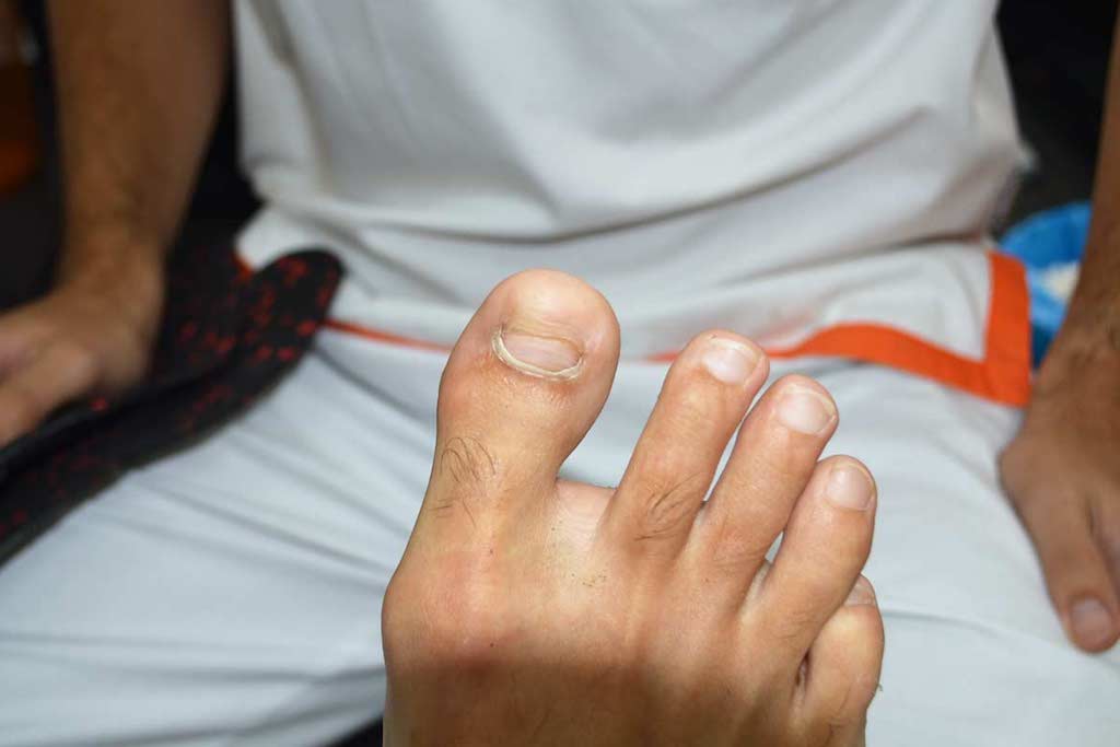 hongos-en-uñas hongos en las uñas